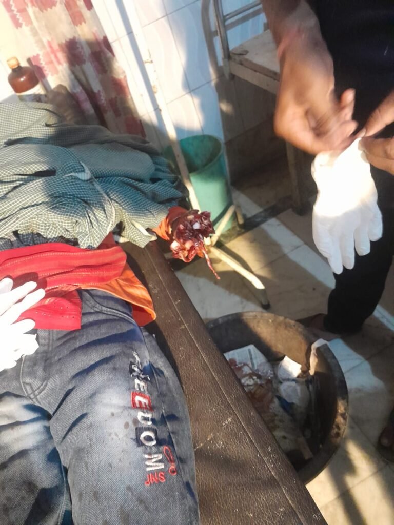 पटाखे की नाल ने मचाया कहर: 12 साल के बच्चे का हाथ बुरी तरह जख्मी, गंभीर हालत में बच्चे को हायर सेंटर किया रेफर